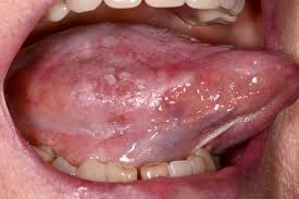 Disease 5